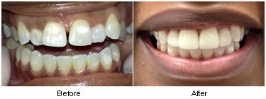 porcelain crowns